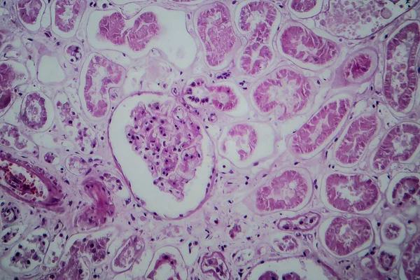 Akutní Glomerulonefritida Světelný Mikrograf Fotografie Pod Mikroskopem — Stock fotografie