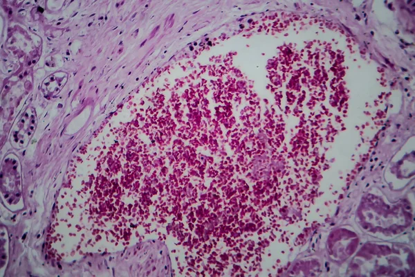 Akut Glomerulonefrit Hafif Mikrograf Mikroskop Altında Fotoğraf — Stok fotoğraf