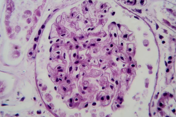 Acute glomerulonephritis, light micrograph, photo under microscope. High magnification