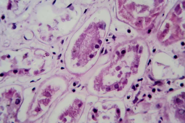 Akute Glomerulonephritis Lichtmikroskopie Foto Unter Dem Mikroskop Hohe Vergrößerung — Stockfoto