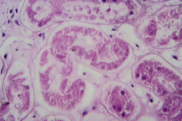 Acute glomerulonephritis, light micrograph, photo under microscope. High magnification