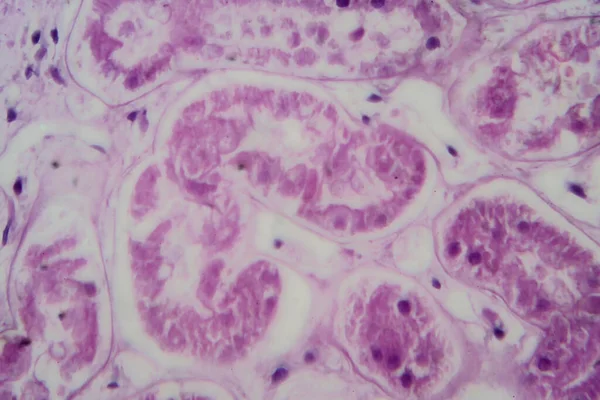 Akute Glomerulonephritis Lichtmikroskopie Foto Unter Dem Mikroskop Hohe Vergrößerung — Stockfoto