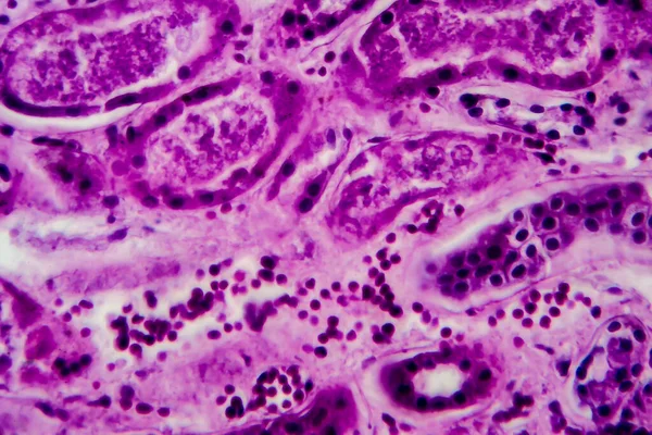Diffuse proliferative glomerulonephritis, light micrograph, photo under microscope. High magnification