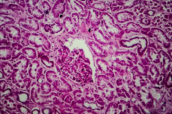 Yaygın Skleroz Glomerulonefrit Işık Mikrografı Mikroskop Altında Fotoğraf — Stok fotoğraf