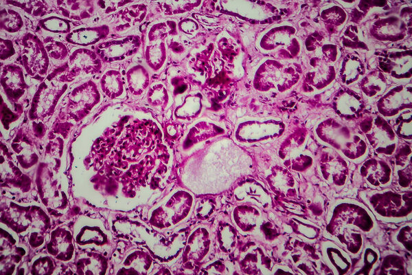 Histopathology of diffuse sclerosing glomerulonephritis, light micrograph, photo under microscope
