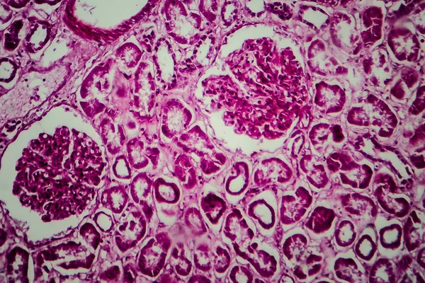 Histopatologia Glomerulonefrite Esclerosante Difusa Micrografia Leve Foto Sob Microscópio — Fotografia de Stock