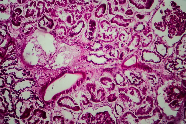 Histopatología Esclerosación Difusa Glomerulonefritis Micrografía Ligera Foto Microscopio — Foto de Stock