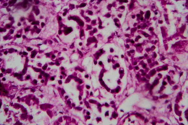 Histopatología Esclerosación Difusa Glomerulonefritis Micrografía Ligera Foto Microscopio — Foto de Stock