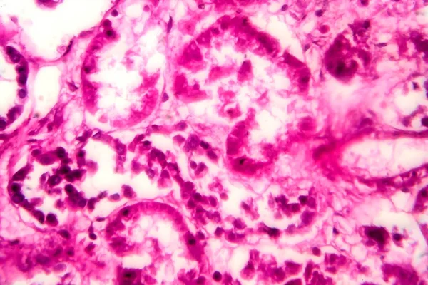 拡散硬化糸球体腎炎 ライトマイクログラフ 顕微鏡下での写真 — ストック写真