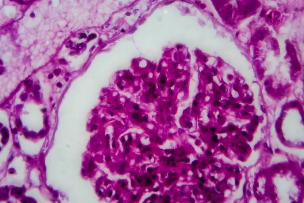 Diffuse sclerosing glomerulonephritis, light micrograph, photo under microscope. High magnification