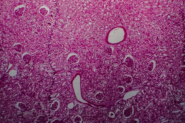 Histopatologia Glomerulonefrite Esclerosante Difusa Micrografia Leve Foto Sob Microscópio — Fotografia de Stock