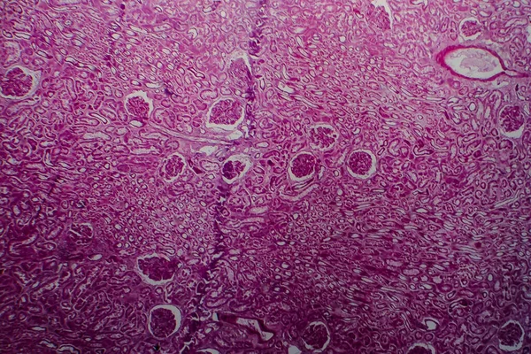 Histopatologia Rozproszonego Zapalenia Kłębuszków Nerkowych Mikrograf Świetlny Zdjęcie Pod Mikroskopem — Zdjęcie stockowe
