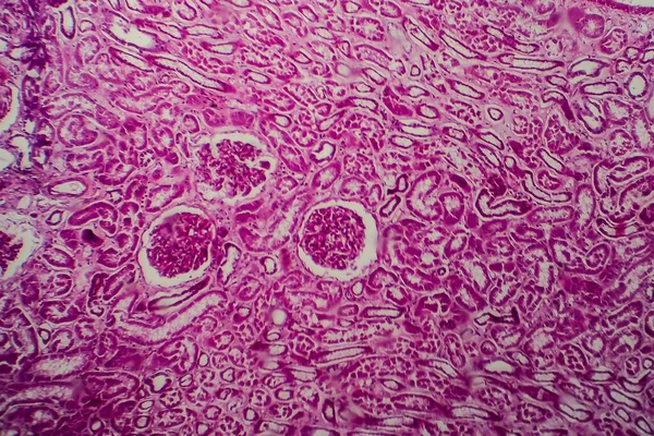 Histopatologia Glomerulonefrite Esclerosante Difusa Micrografia Leve Foto Sob Microscópio — Fotografia de Stock