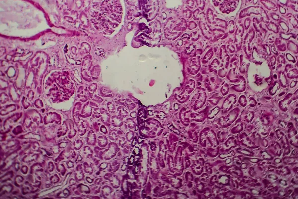 Histopatologie Difuzní Sklerotizující Glomerulonefritidy Světelný Mikrograf Fotografie Pod Mikroskopem — Stock fotografie
