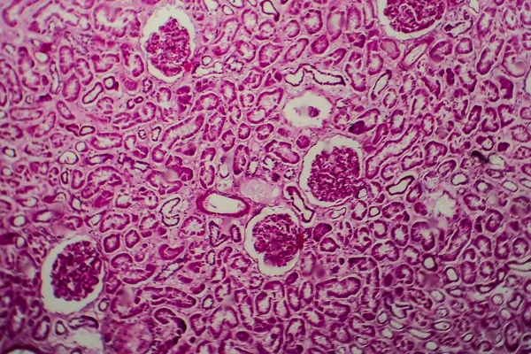 Diffúz Szklerózis Szövettani Vizsgálata Glomerulonephritis Fénymikrográf Fénykép Mikroszkóp Alatt — Stock Fotó