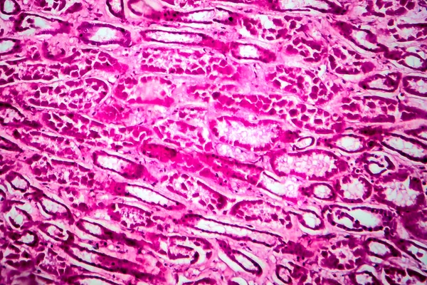 Histopatologia Glomerulonefrite Esclerosante Difusa Micrografia Leve Foto Sob Microscópio — Fotografia de Stock