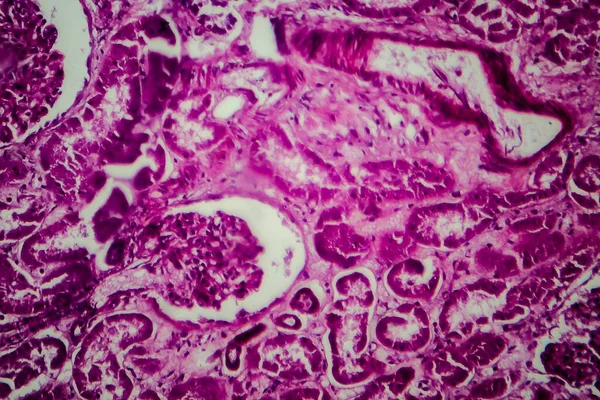 Histopatología Esclerosación Difusa Glomerulonefritis Micrografía Ligera Foto Microscopio — Foto de Stock