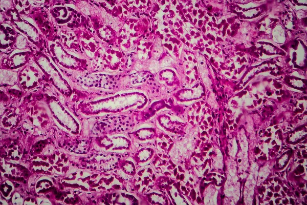 Ιστολογία Διάχυτης Σκληρωτικής Σπειραματονεφρίτιδας Ανοιχτού Μικρογράφου Φωτογραφία Στο Μικροσκόπιο — Φωτογραφία Αρχείου