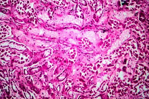 Histopatologia Rozproszonego Zapalenia Kłębuszków Nerkowych Mikrograf Świetlny Zdjęcie Pod Mikroskopem — Zdjęcie stockowe