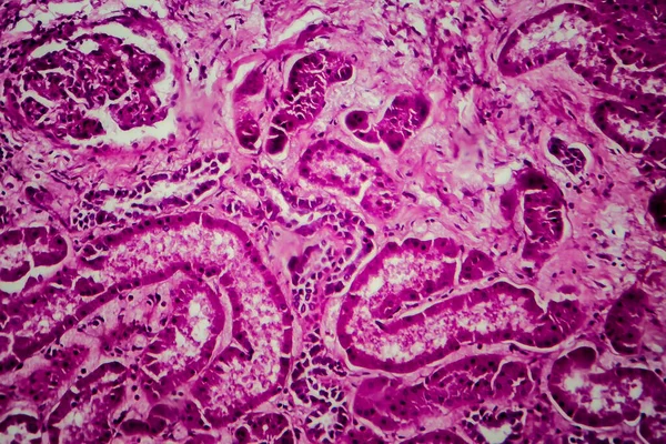 Yaygın skleroz glomerulonefrit, ışık mikrografı, mikroskop altında fotoğraf.