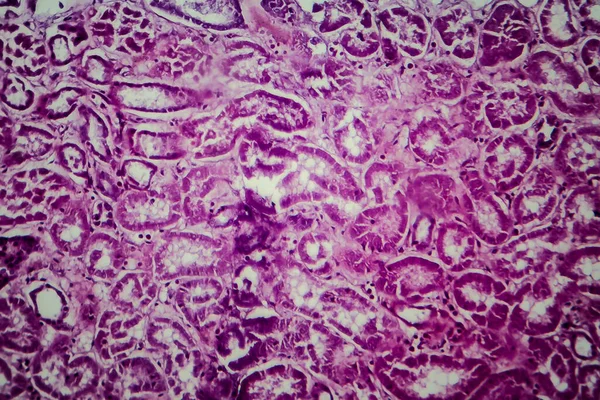 Histopatologie Difuzní Sklerotizující Glomerulonefritidy Světelný Mikrograf Fotografie Pod Mikroskopem — Stock fotografie