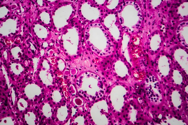 Atrofia Tubular Micrografia Luz Foto Sob Microscópio — Fotografia de Stock