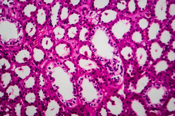 Atrofia Tubular Micrografia Luz Foto Sob Microscópio — Fotografia de Stock