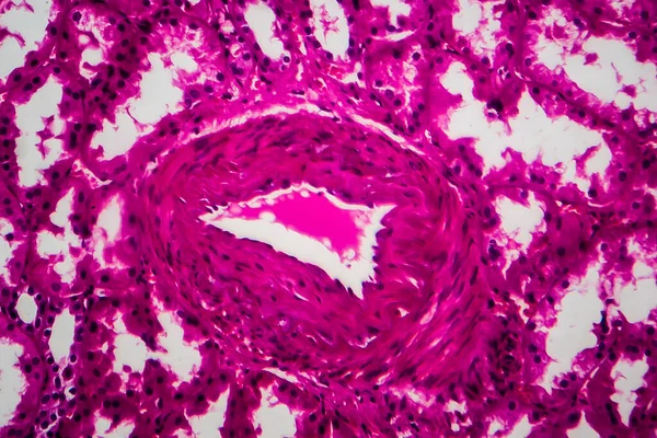 Tubular Atrophy Light Micrograph Photo Microscope High Magnification — Stock Photo, Image