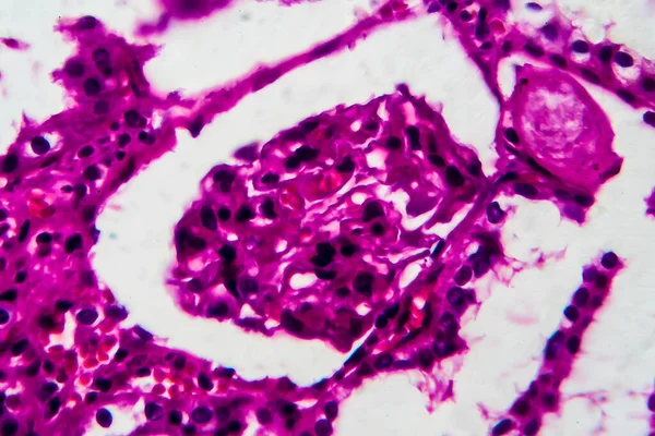Atrofia Tubular Micrografía Ligera Foto Bajo Microscopio Alto Aumento —  Fotos de Stock