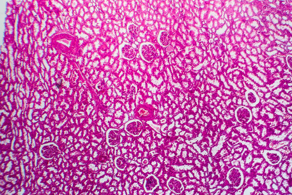 Tubular atrophy, light micrograph, photo under microscope