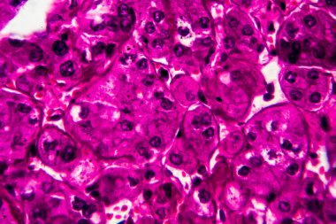 Böbrek kanseri, ışık mikrografı, mikroskop altında fotoğraf. Yüksek büyütme