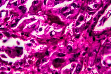 Böbrek kanseri, ışık mikrografı, mikroskop altında fotoğraf. Yüksek büyütme