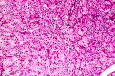 Böbrek kanseri, hafif mikrograf, mikroskop altında fotoğraf.