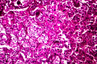 Böbrek kanseri, hafif mikrograf, mikroskop altında fotoğraf.