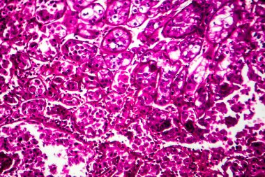 Böbrek kanseri, hafif mikrograf, mikroskop altında fotoğraf.