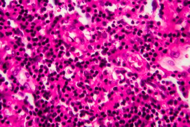 Mesane kanseri, hafif mikrograf, mikroskop altında fotoğraf. Yüksek büyütme