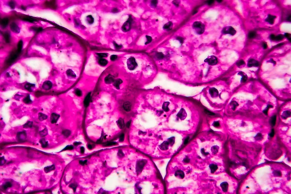 Nierenkrebs Lichtmikroskopie Foto Unter Dem Mikroskop Hohe Vergrößerung — Stockfoto