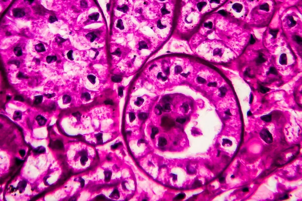 Nierkanker Lichtmicrograaf Foto Onder Microscoop Hoge Vergroting — Stockfoto