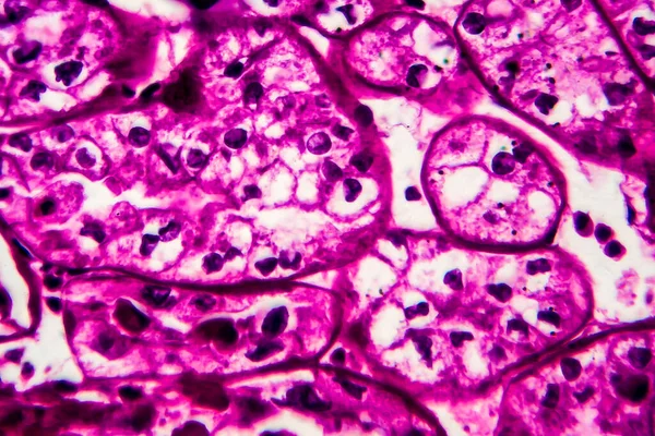 Cáncer Riñón Micrografía Ligera Foto Bajo Microscopio Alto Aumento — Foto de Stock