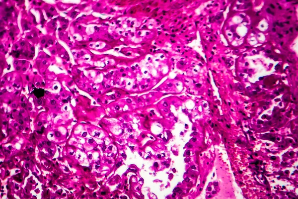 Cancro Reni Microscopio Luce Foto Microscopio — Foto Stock