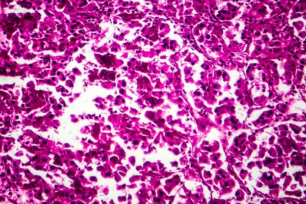 Rakovina Ledvin Světelný Mikrograf Fotografie Pod Mikroskopem — Stock fotografie