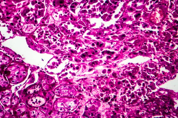 Rakovina Ledvin Světelný Mikrograf Fotografie Pod Mikroskopem — Stock fotografie
