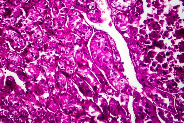 Καρκίνος Νεφρού Μικρογραφία Φωτός Φωτογραφία Στο Μικροσκόπιο — Φωτογραφία Αρχείου