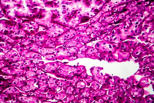Cancro Rim Micrografia Luz Foto Sob Microscópio — Fotografia de Stock