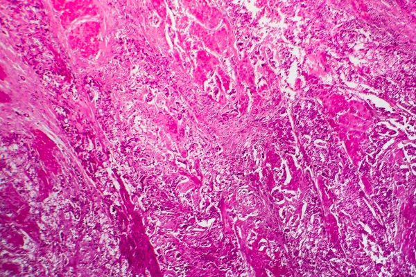 Bladder cancer, light micrograph, photo under microscope
