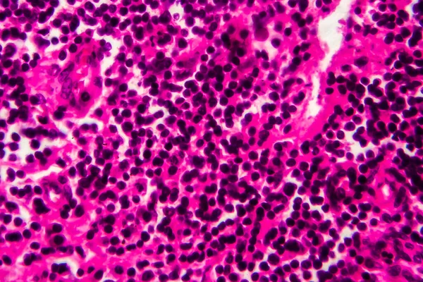 Rakovina Močového Měchýře Světelný Mikrograf Fotografie Pod Mikroskopem Vysoké Zvětšení — Stock fotografie