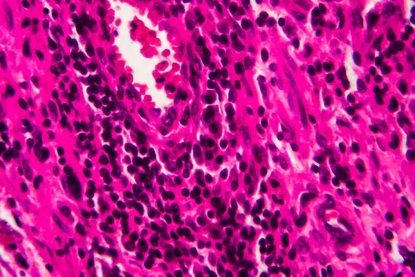 Bladder cancer, light micrograph, photo under microscope. High magnification