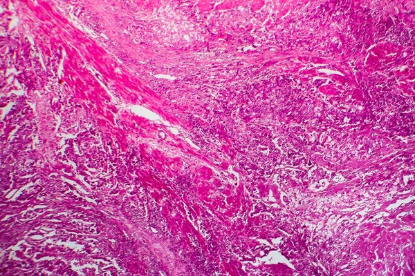 Bladder cancer, light micrograph, photo under microscope