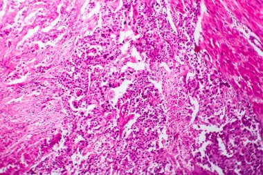 Mesane kanseri, hafif mikrograf, mikroskop altında fotoğraf.