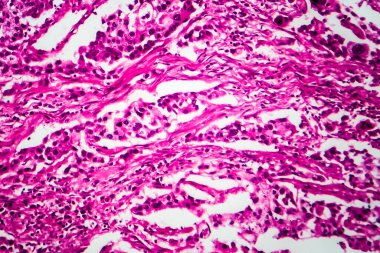 Mesane kanseri, hafif mikrograf, mikroskop altında fotoğraf.